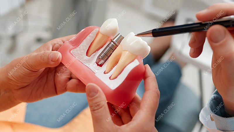 dental implants